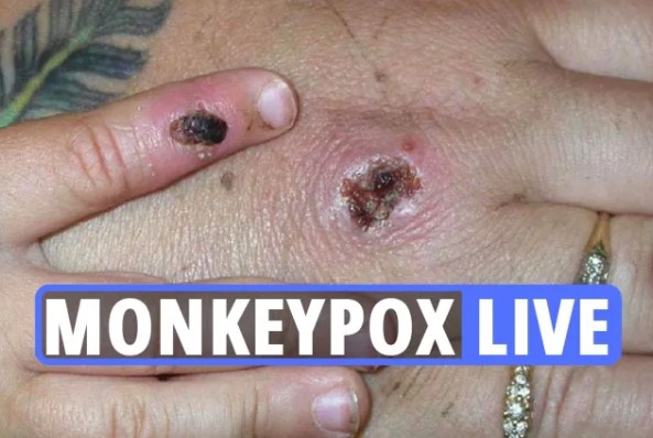 Monkeypox can be contained ‘if we act now’ says WHO