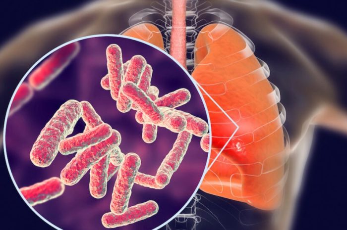 What Nigeria must do to eradicate Tuberculosis by 2030 – Health experts