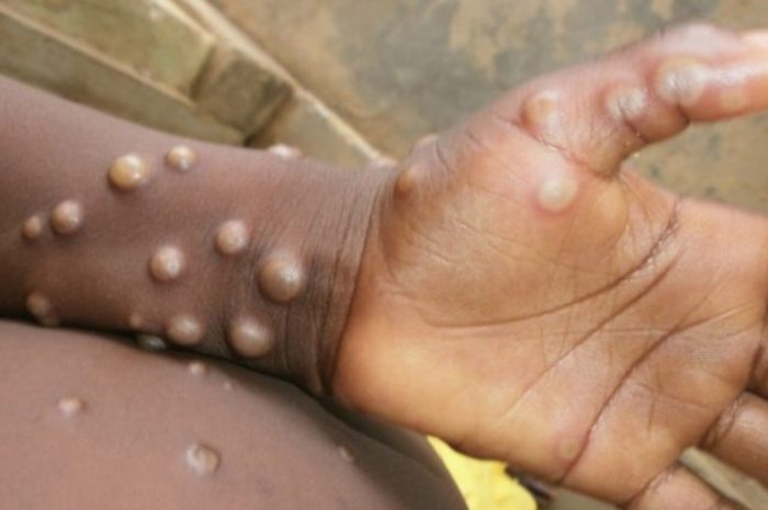 Multi-country monkeypox outbreak declared a global Public Health Emergency of International Concern